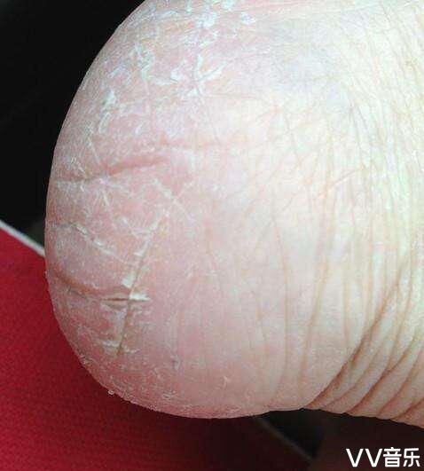 治脚跟皲裂的小妙招